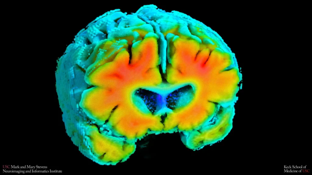 amyloid pet brain scan.webp.webp
