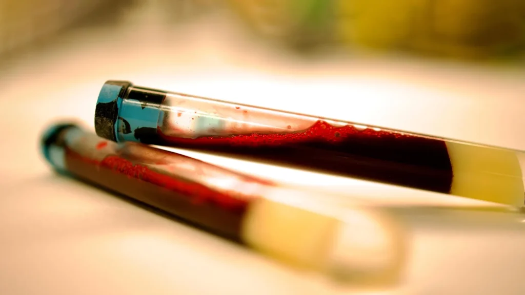 blood sample for parkinsons test.webp.webp