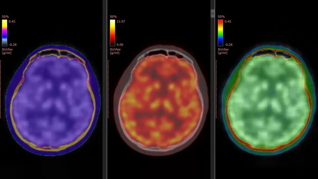 Mind scans disclose how ketamine briefly lifts serious melancholy pet ct scan of human brain triple view.webp.webp