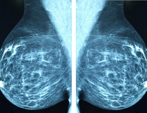 Nutrition D deficiency related to raised postoperative breast most cancers ache tagimage 1039 45840826385648151818 620x480.jpg