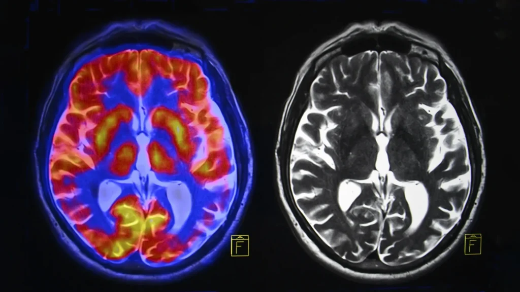 Mind scans disclose two distinct sorts of autism brain scan color black and white.webp.webp