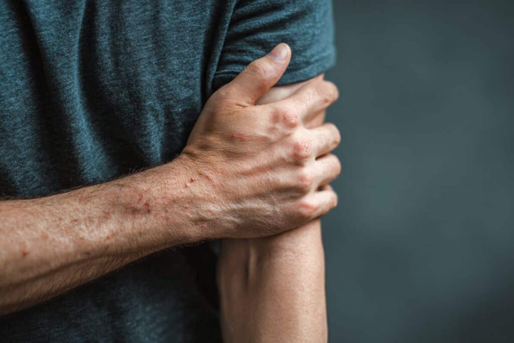 Contact Neurons That Power Persistent Eczema Itch Printed chronic itch peaches neuroscience.jpg