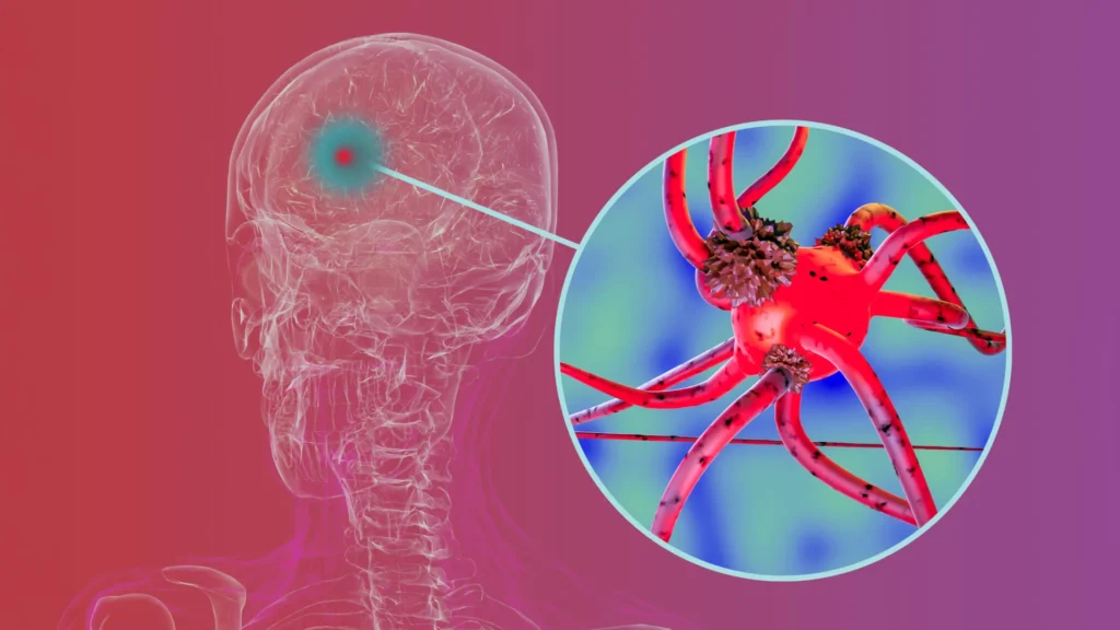 Researchers block key protein that is helping Parkinson’s unfold during the mind human brain cells affected by parkinsons disease.webp.webp